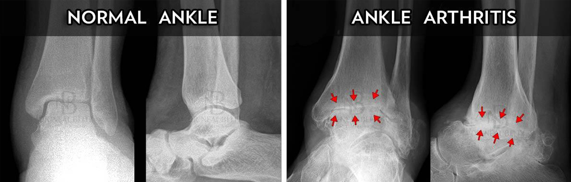 Ankle Arthritis