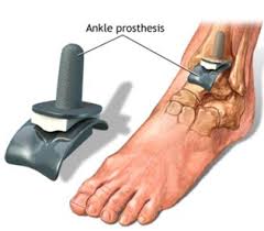 Ankle prosthesis