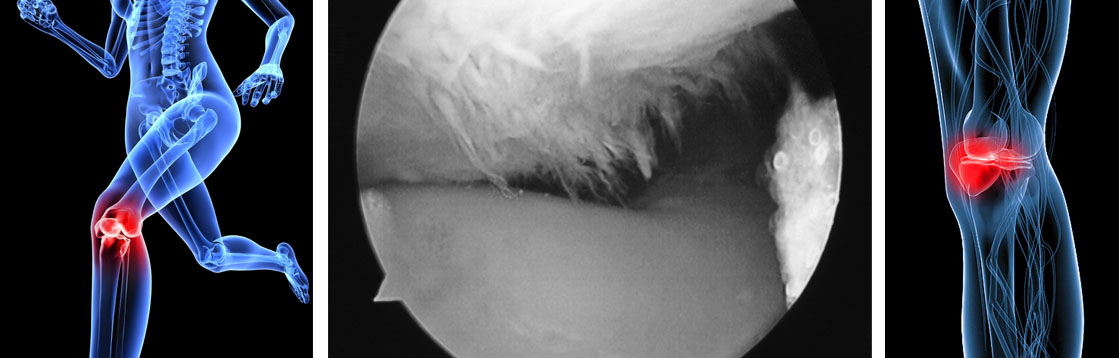 Knee pain