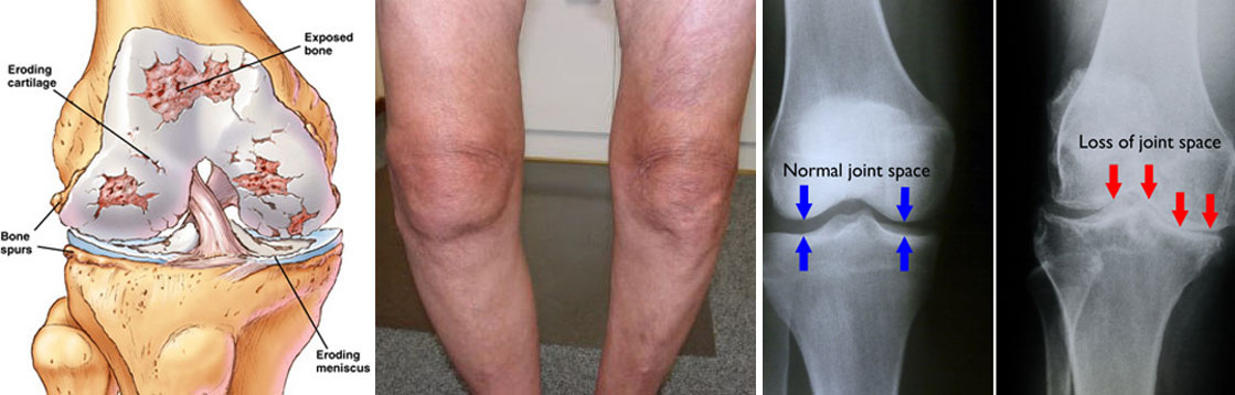 Knee joint