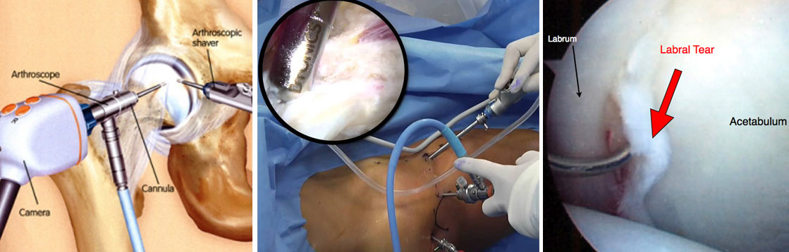 Hip arthroscopy