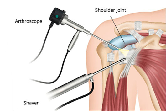 shoulder instability