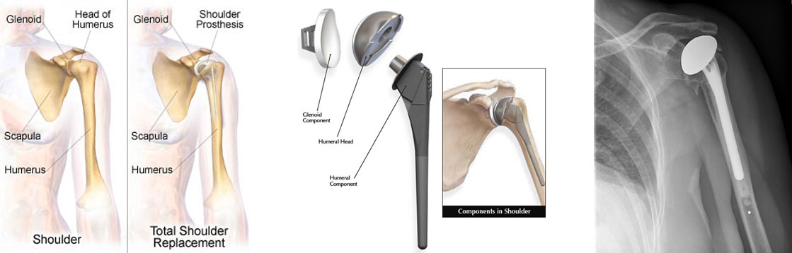 Total shoulder replacement