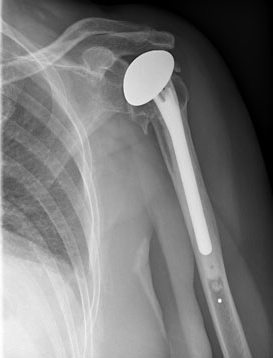 shoulder replacement
