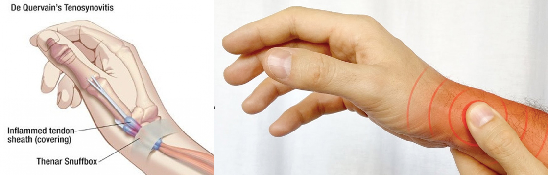 De Quervain's Tenosynovitis